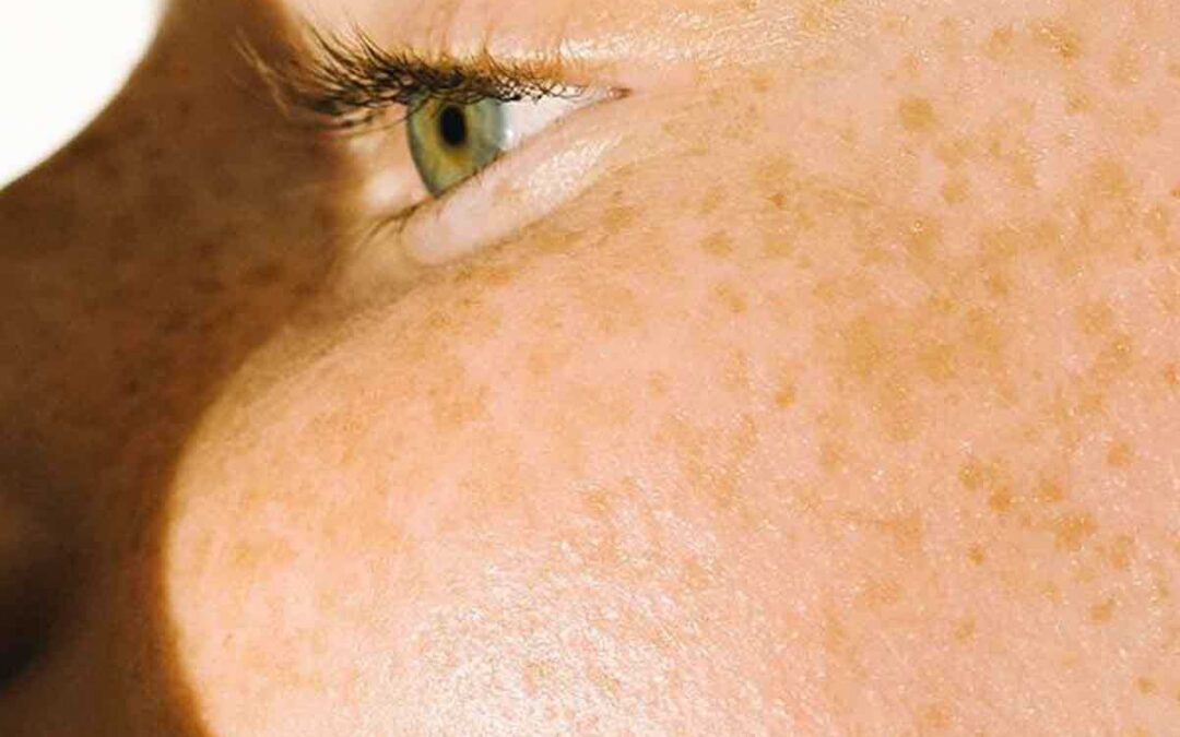 Cover image of the article Top 3 Ingredients to Look for in Skincare Products for Melasma and Chloasma showing a woman with chloasma symptoms