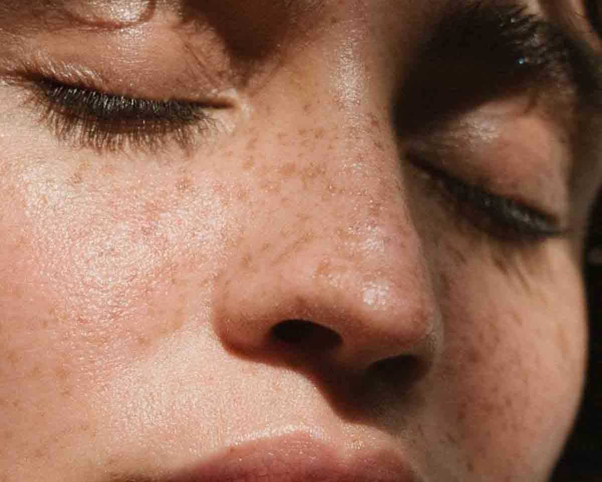 Cover image of the article Understanding the Causes of Melasma: A Guide to Hormones, Sun Exposure, and Genetics showing a woman with melasma